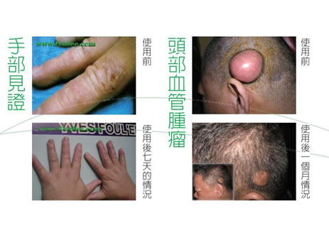 8年使用藥物治療經年不癔